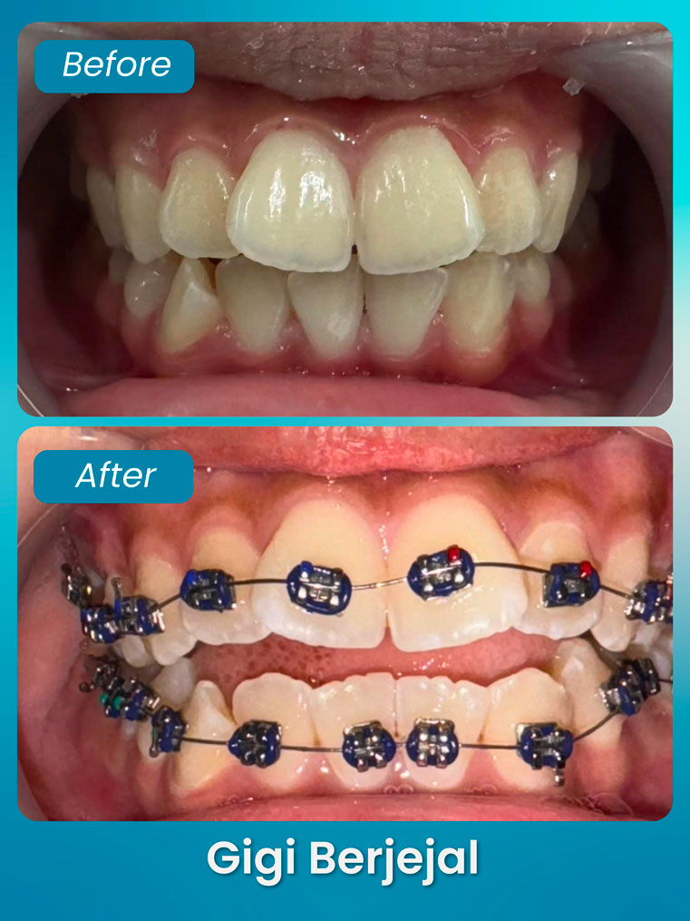 masalah gigi bawah berjejal - klinik pergigian bluvia dental