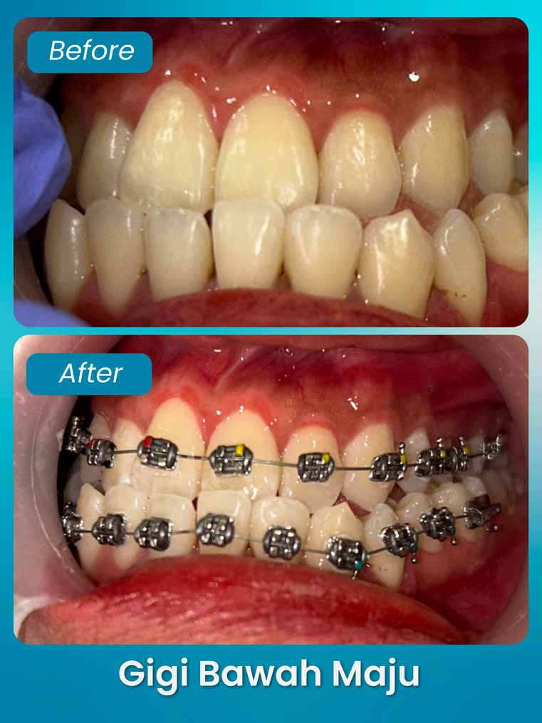 masalah gigi bawah maju - klinik pergigian bluvia dental