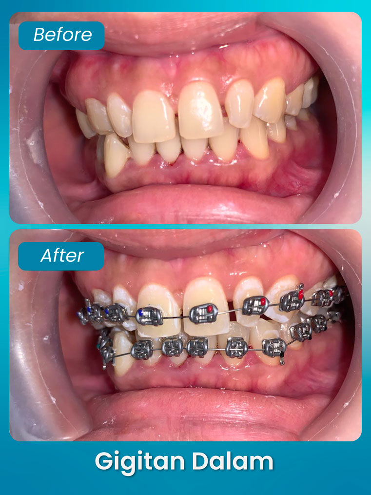 masalah gigitan dalam - klinik pergigian bluvia dental