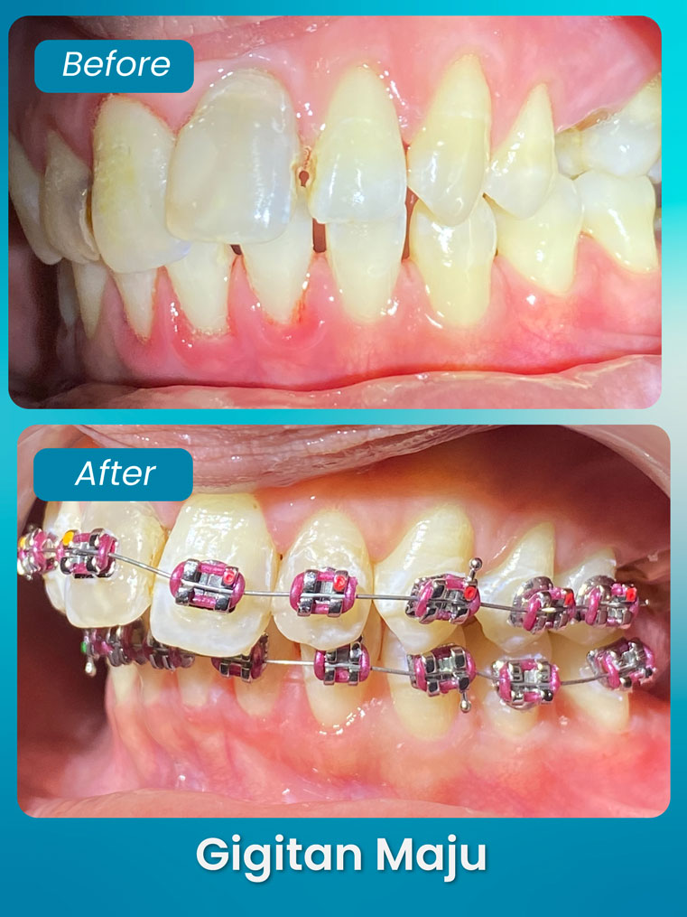 masalah gigitan maju - klinik pergigian bluvia dental