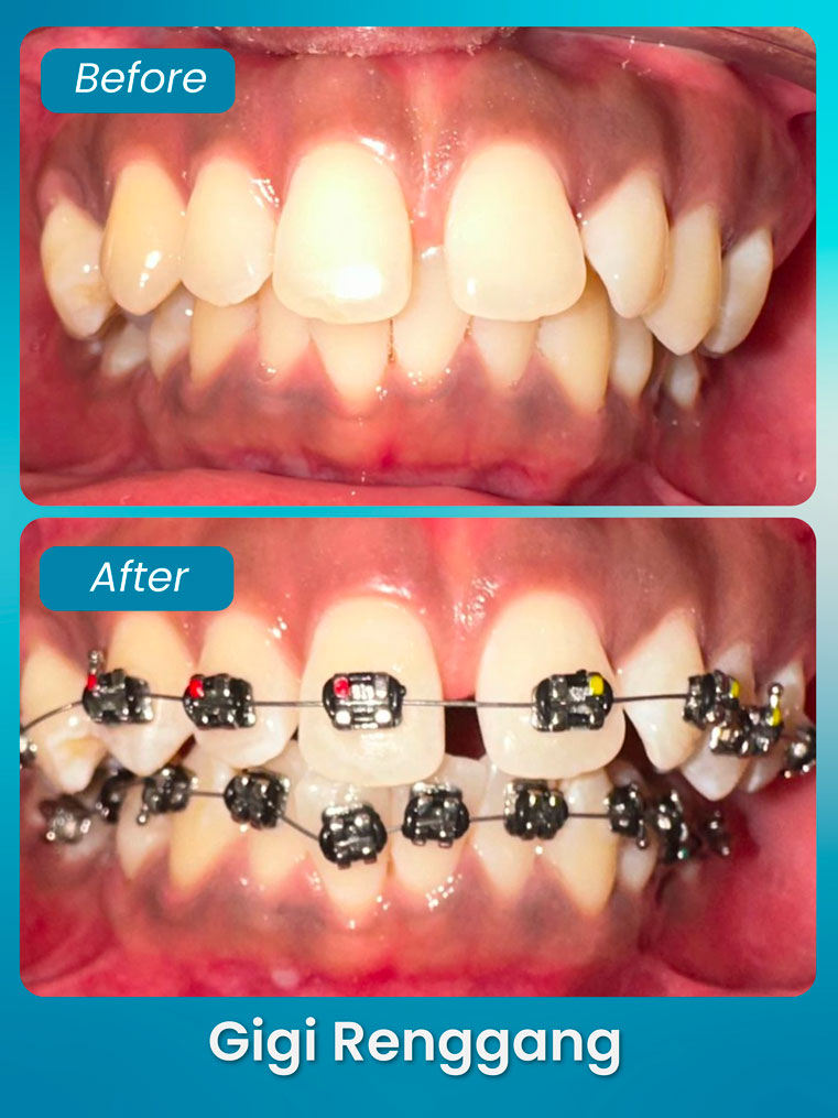 masalah gigitan renggang - klinik pergigian bluvia dental